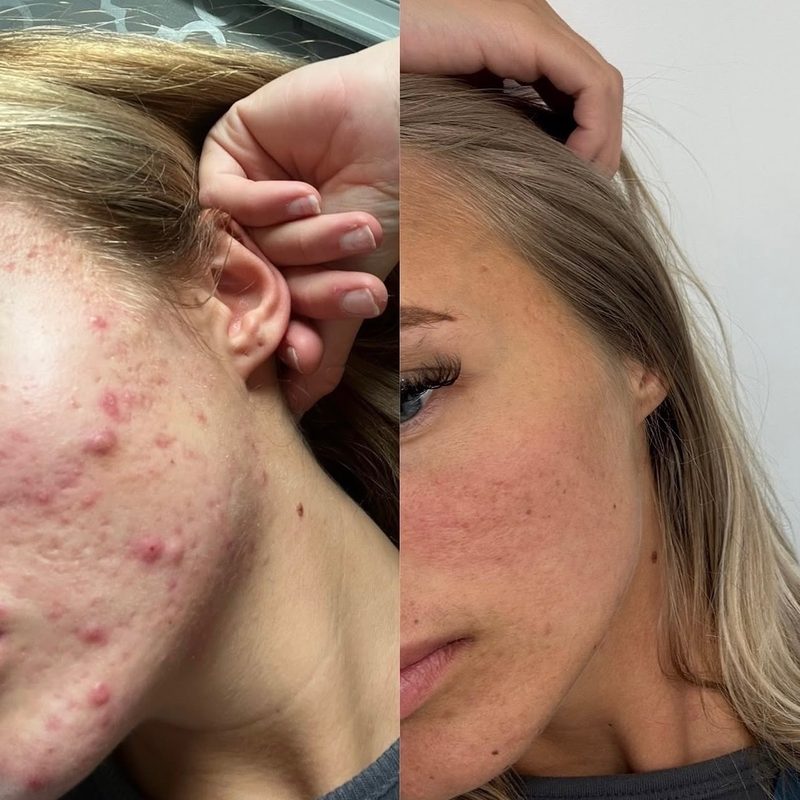 Client skin before and after — acne and scarring on one cheek, brighter, clearer skin after treatment.